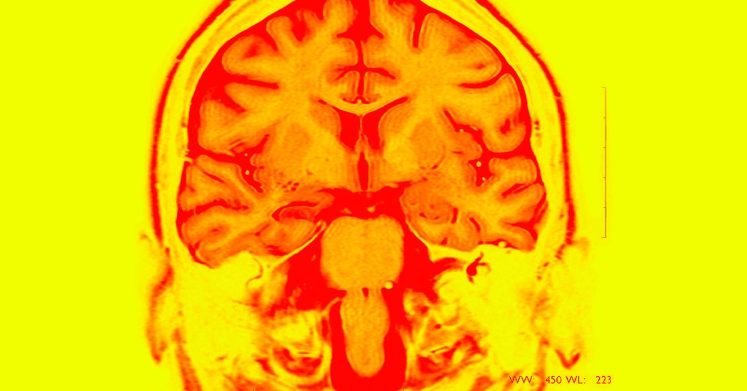 A Brain Implant Improved Memory, Scientists Report